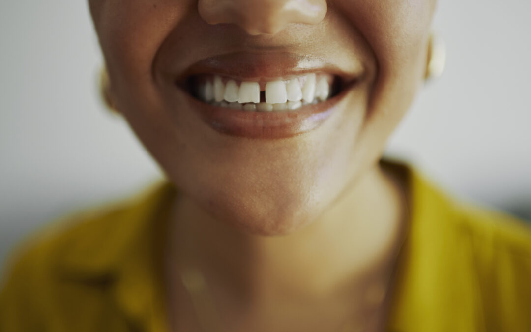 Dientes separados: ¿Es el diastema un problema estético o funcional? | Fio Dental