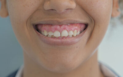 Sonrisa gingival: causas y tratamientos para mejorar tu sonrisa