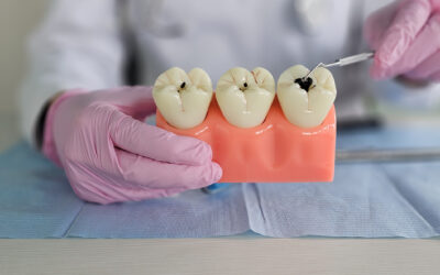 ¿Por qué algunas caries no molestan ni tampoco duelen?